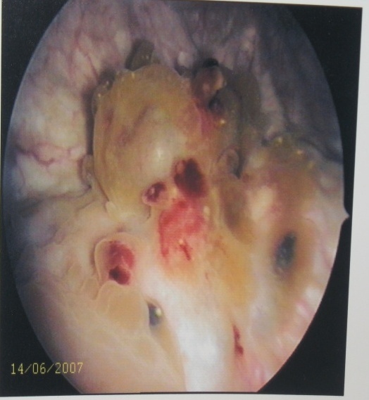 Лапароскопические оперативные вмешательства при ретроцервикальном эндометриозе с поражением кишки, мочевого пузыря и мочеточников.