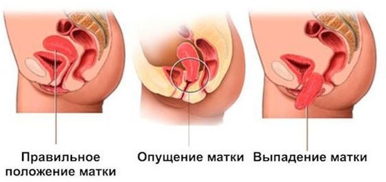Пролапс гениталий