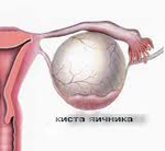 Дермоидная киста яичников (тератома) - лапароскопия, удаление, лечение кист яичника, операция. Как лечить дермоидную кисту яичника?