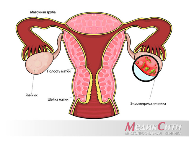 Осложнения эндометриоза - чем опасен эндометриоз матки?