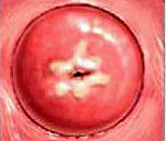Дисплазия шейки матки (CIN) - диагностика, симптомы, лечение - Материал