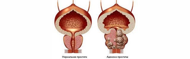 Хирургическая операция и лапароскопия в лечении опухолей (аденома, феохромоцитома, кортикостерома, альдостерома) надпочечника