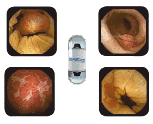 Капсульная эндоскопия в диагностике заболеваний тонкой и толстой кишки PillCam™ COLON system