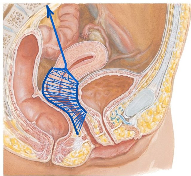 Облегченная промонтофиксация с вагинальной пластикой собственными тканями