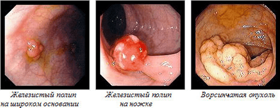 Полипы и болезни эндометрия - симптомы, причины, диагностика