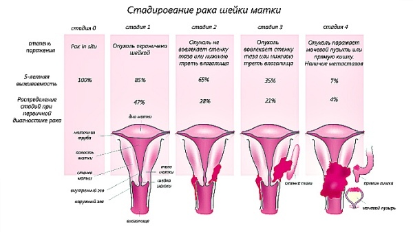 Рак шейки матки - методы лечения, диагностика, причины, симптомы.