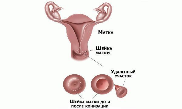 Дисплазия шейки матки (CIN) - диагностика, симптомы, лечение - Материал