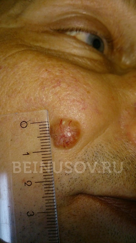 Виды онкологических заболеваний кожи - меланома, базалиома, лечение ФТД
