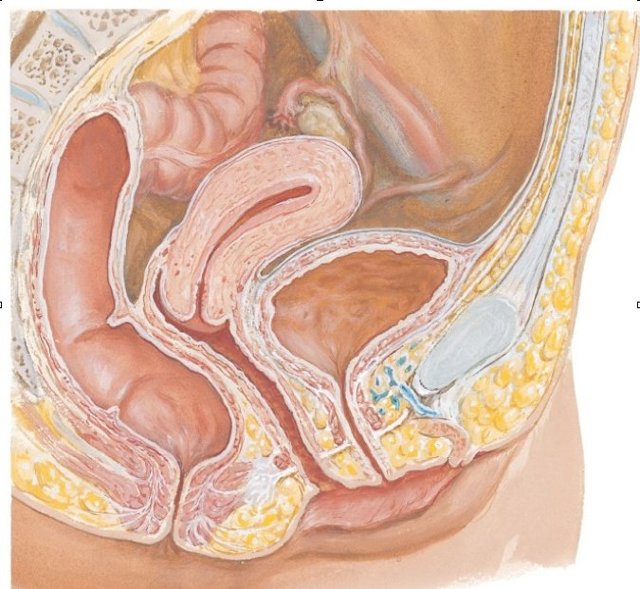 Лечение пролапса гениталий, выпадения и опущения матки и стенок влагалища. Лапароскопическая промонтофиксация