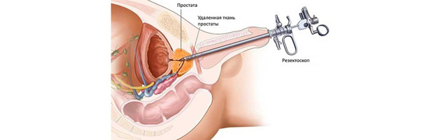 Хирургическая операция и лапароскопия в лечении опухолей (аденома, феохромоцитома, кортикостерома, альдостерома) надпочечника