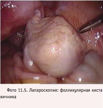 Операции при кисте яичника - лапароскопия