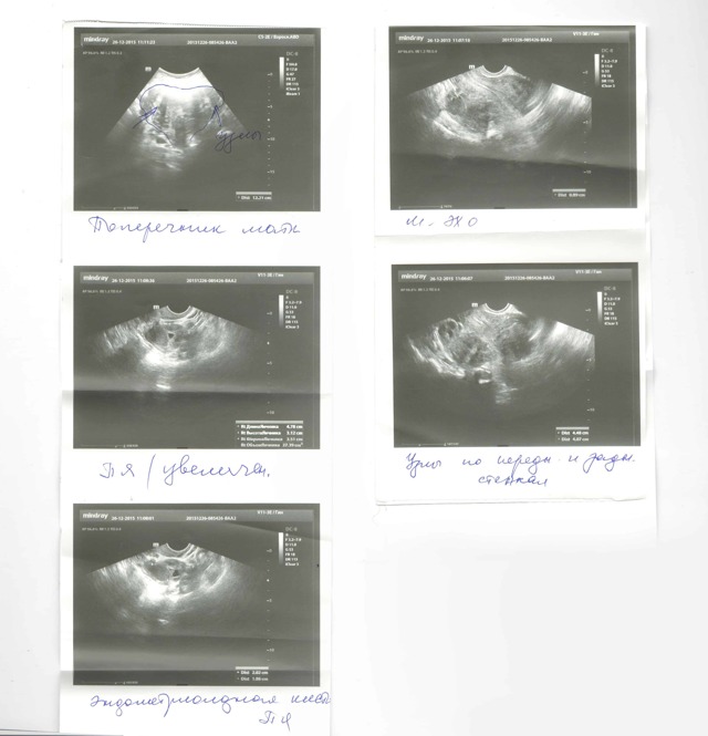 Миома матки - размеры в неделях (2-2,5 см - 4-5 недель, 5-6 см - 10-12 недель, более 8 см - 13-15 недель беременности