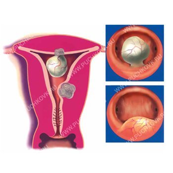 Гистероскопическая миомэктомия в лечении миомы матки