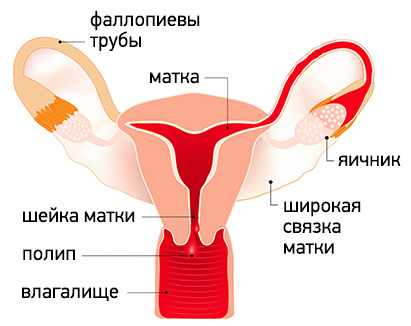 Гистероскопическое лечение полипов и болезней эндометрия