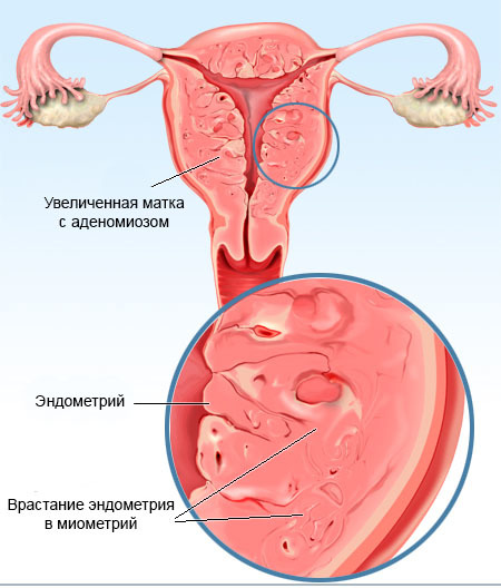 Удаление матки при лечении аденомиоза