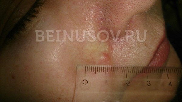 Виды онкологических заболеваний кожи - меланома, базалиома, лечение ФТД