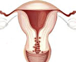 Наружный эндометриоз у женщин - симптомы, диагностика и лечение