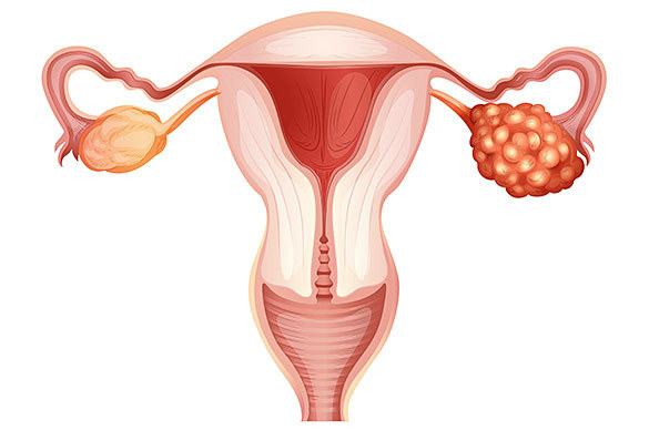 Рак яичников у женщин - лечение, симптомы, диагностика, прогноз выживаемости.