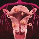 Беременность после удаления миомы матки лапароскопическим и открытым методами