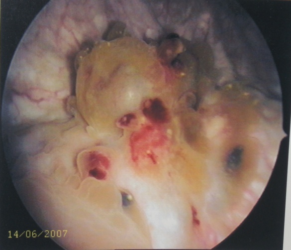 Лапароскопические оперативные вмешательства при ретроцервикальном эндометриозе с поражением кишки, мочевого пузыря и мочеточников.