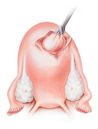 Лапароскопическая миомэктомия в лечении миомы матки