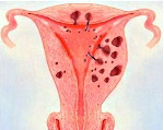 Аденомиоз матки - симптомы, признаки, диагностика, особенности аденомиоза при беременности