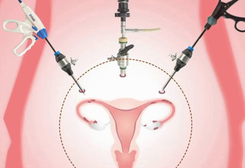 Органосохраняющая лапароскопическая операция при миоме матки