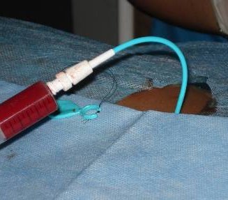Методы лечения кист надпочечника - лапароскопические операции с сохранением органа