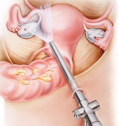 Лапароскопические операции на маточных трубах при хроническом сальпингите, бесплодии и внематочной беременности.