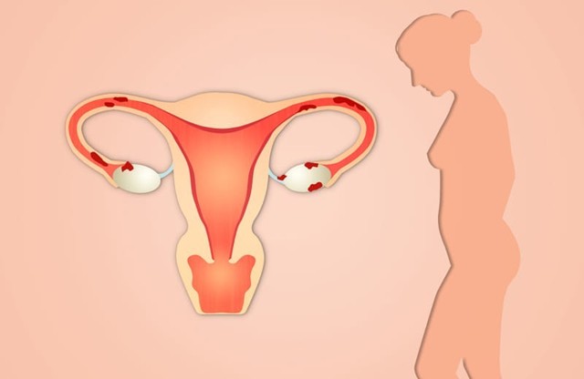 Рак тела матки