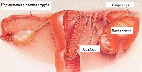 Лечение заболеваний маточных труб (гидросальпинкса и сальпингита) без скальпеля