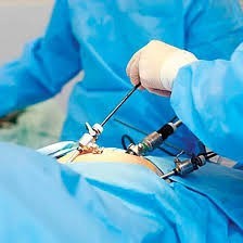 Операция по удалению спаек в малом тазу - лапароскопия, восстановление после операции