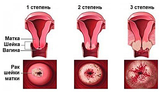Рак шейки матки 1 стадии - симптомы, лечение, операция, прогноз.