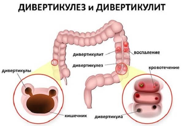 Отзывы пациентов прооперированных проф. Пучковым с дивертикулезом толстой кишки