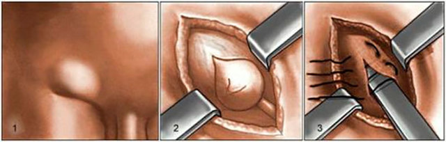 Лапароскопическая герниопластика с применением сетчатых имплантов