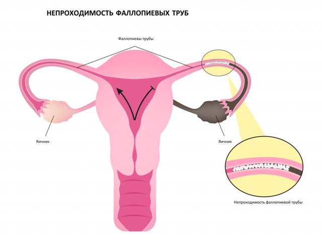 Женское бесплодие - классификация, диагностика, методы лечения