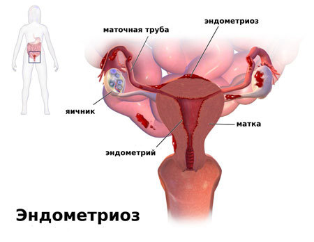 Ретроцервикальный эндометриоз