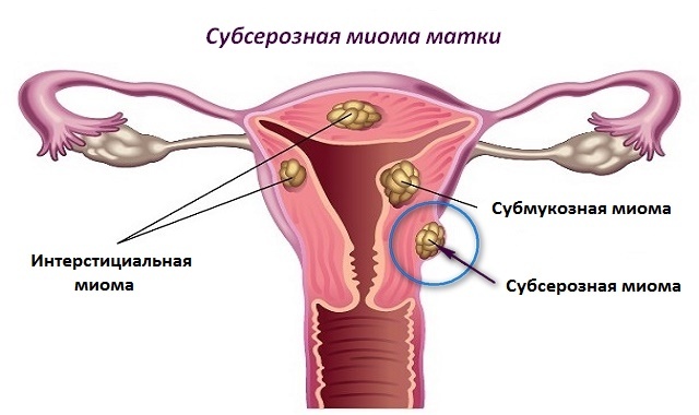 Субсерозная миома матки - лечение, удаление, операция, лапароскопия.