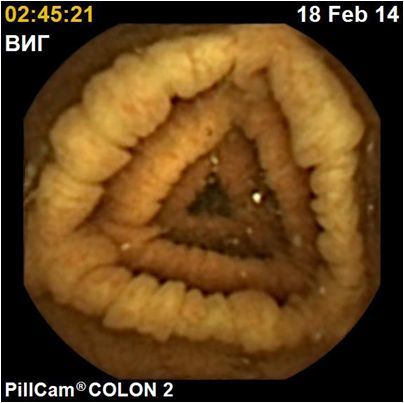 Капсульная эндоскопия в диагностике заболеваний тонкой и толстой кишки PillCam™ COLON system