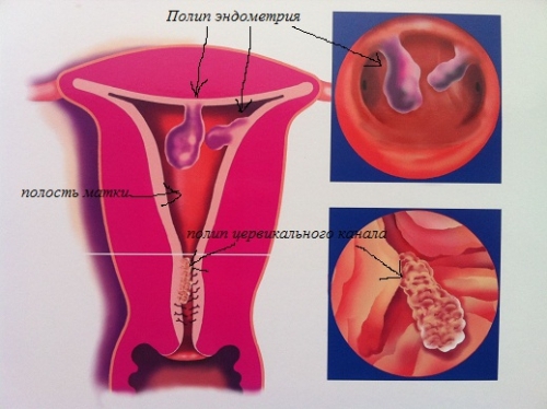 Гистероскопическое лечение полипов и болезней эндометрия