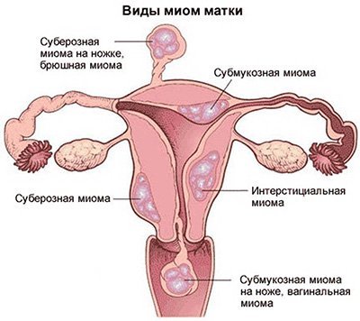Миома матки - размеры в неделях (2-2,5 см - 4-5 недель, 5-6 см - 10-12 недель, более 8 см - 13-15 недель беременности