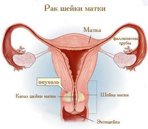 Рак шейки матки - методы лечения, диагностика, причины, симптомы.