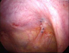 Методы лечения эндометриоза - лапароскопическая операция